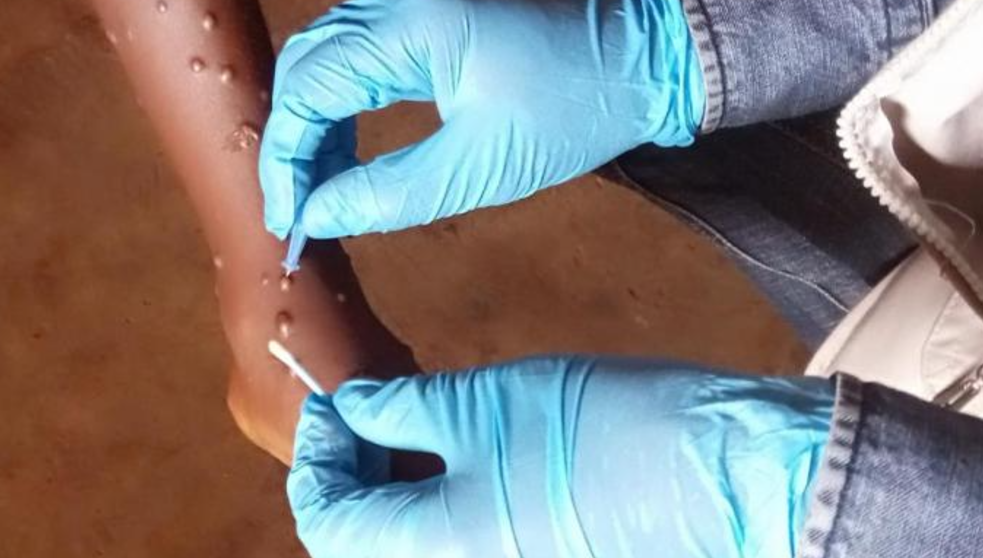 Mpox outbreak: Key steps 5 West African countries have rolled out Mpox outbreak: Key steps 5 West African countries have rolled out